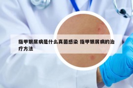 指甲银屑病是什么真菌感染 指甲银屑病的治疗方法