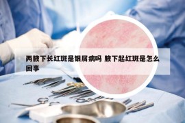 两腋下长红斑是银屑病吗 腋下起红斑是怎么回事