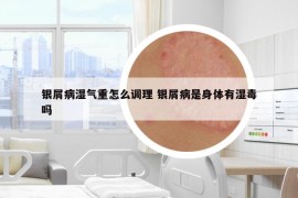 银屑病湿气重怎么调理 银屑病是身体有湿毒吗