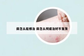 藓怎么能根治 藓怎么彻底治好不复发