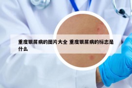 重度银屑病的图片大全 重度银屑病的标志是什么