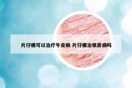 片仔癀可以治疗牛皮癣 片仔癀治银屑病吗