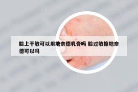 脸上干敏可以用地奈德乳膏吗 脸过敏擦地奈德可以吗