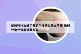 榆树叶汁治好了我的牛皮癣为什么不痒 榆树汁治疗银屑病要多久