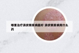 哪里治疗滴状银屑病最好 滴状银屑病用什么药