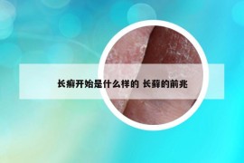 长癣开始是什么样的 长藓的前兆