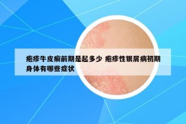 疱疹牛皮癣前期是起多少 疱疹性银屑病初期身体有哪些症状