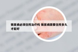 银屑病必须住院治疗吗 银屑病需要住院多久才能好