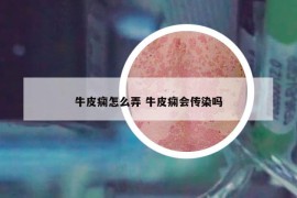 牛皮痫怎么弄 牛皮痫会传染吗