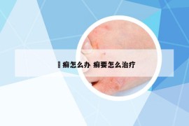 圏癣怎么办 癣要怎么治疗