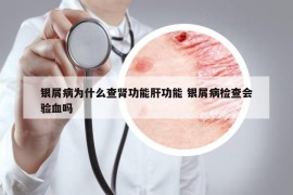 银屑病为什么查肾功能肝功能 银屑病检查会验血吗