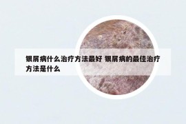 银屑病什么治疗方法最好 银屑病的最佳治疗方法是什么