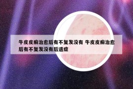 牛皮皮癣治愈后有不复发没有 牛皮皮癣治愈后有不复发没有后遗症