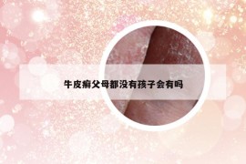 牛皮癣父母都没有孩子会有吗