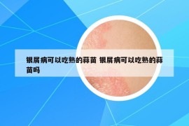 银屑病可以吃熟的蒜苗 银屑病可以吃熟的蒜苗吗