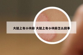 大腿上有小块藓 大腿上有小块藓怎么回事