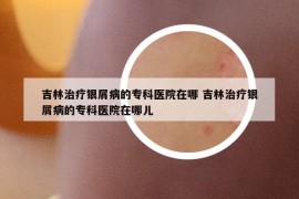 吉林治疗银屑病的专科医院在哪 吉林治疗银屑病的专科医院在哪儿