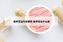 指甲花治牛皮癣吗 指甲花治什么病