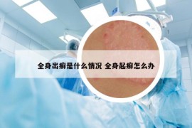 全身出癣是什么情况 全身起癣怎么办