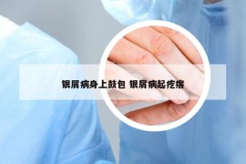 银屑病身上鼓包 银屑病起疙瘩