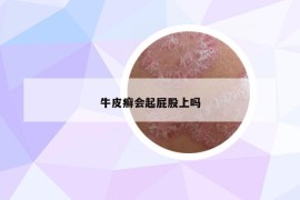 牛皮癣会起屁股上吗