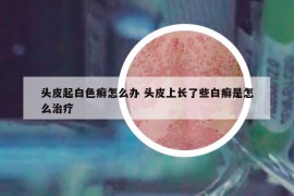 头皮起白色癣怎么办 头皮上长了些白癣是怎么治疗