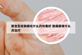 脓包型皮肤癣吃什么药效果好 脓疱癣用什么药治疗