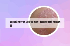 太阳癣用什么药膏最有效 太阳癣治疗用啥药膏