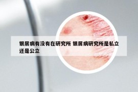 银屑病有没有在研究所 银屑病研究所是私立还是公立