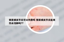 银屑病关节炎可以热敷吗 银屑病关节炎能用热水泡脚吗??