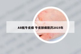 AB瓶牛皮癣 牛皮肤癣新药2019年