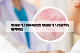 银屑病对人的影响程度 银屑病对人的最大伤害有哪些