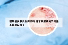 银屑病关节炎会传染吗 得了银屑病关节炎是不是就没救了