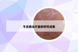 牛皮癣治疗最新研究成果