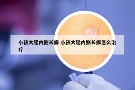 小孩大腿内侧长癣 小孩大腿内侧长癣怎么治疗