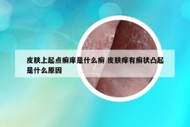 皮肤上起点癣庠是什么癣 皮肤痒有癣状凸起是什么原因