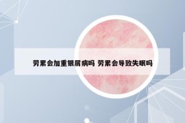 劳累会加重银屑病吗 劳累会导致失眠吗