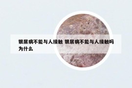 银屑病不能与人接触 银屑病不能与人接触吗为什么