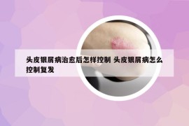 头皮银屑病治愈后怎样控制 头皮银屑病怎么控制复发