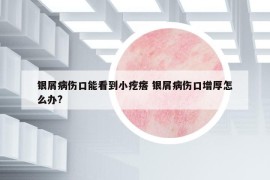 银屑病伤口能看到小疙瘩 银屑病伤口增厚怎么办?