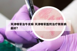 天津哪家治牛皮癣 天津哪家医院治疗银屑病最好?