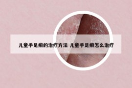 儿童手足癣的治疗方法 儿童手足癣怎么治疗