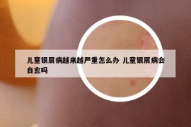 儿童银屑病越来越严重怎么办 儿童银屑病会自愈吗