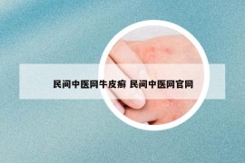 民间中医网牛皮癣 民间中医网官网