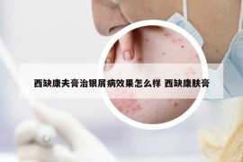 西缺康夫膏治银屑病效果怎么样 西缺康肤膏