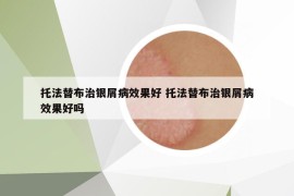 托法替布治银屑病效果好 托法替布治银屑病效果好吗