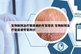 生物制剂治疗银屑病的开发现状 生物制剂治疗银屑病专家共识