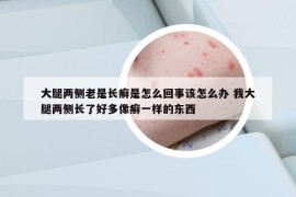 大腿两侧老是长癣是怎么回事该怎么办 我大腿两侧长了好多像癣一样的东西