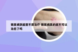 银屑病到底需不需治疗 银屑病真的就不可以治愈了吗