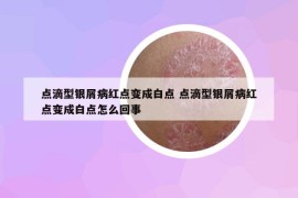 点滴型银屑病红点变成白点 点滴型银屑病红点变成白点怎么回事